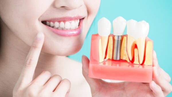  Implante Dentário Pelo SUS